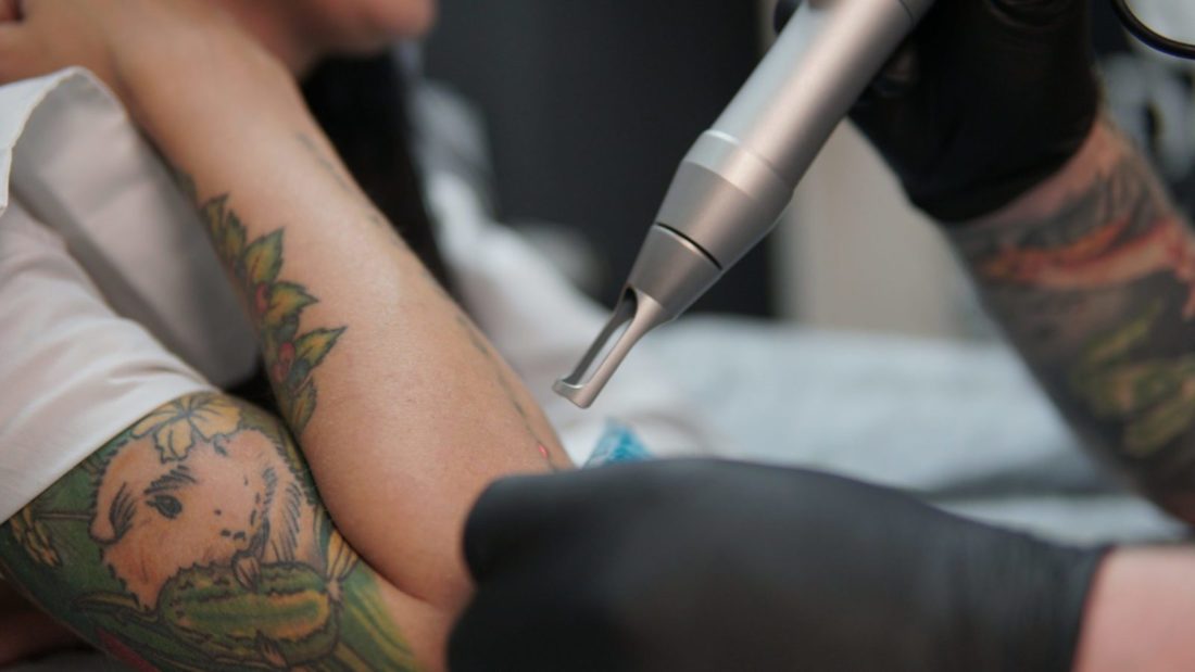 Почему старые татуировки удаляются лучше чем сделанные недавно