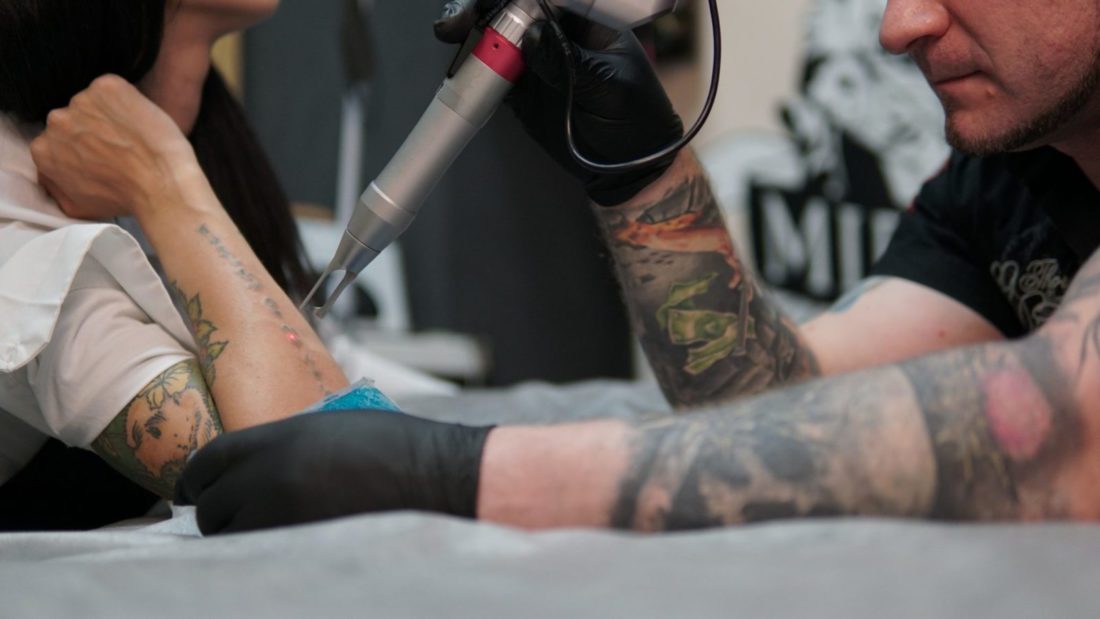 лазерное удаление татуировок цена